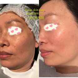 Susie Skin Care Clinic - Discoloration treatment