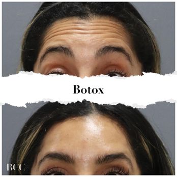 Brickell Cosmetic Center - Miami Botox Transformation! Smooth lines, refreshed look! Check out these stunning before & after results. #MiamiAesthetics - Medical Spas Near Me - Miami, Florida Brickell Cosmetic Center - Miami Botox Transformation! Smooth lines, refreshed look! Check out these stunning before & after results. #MiamiAesthetics - Medical Spas Near Me - Miami, Florida