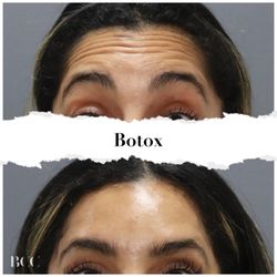 Brickell Cosmetic Center - Miami Botox Transformation! Smooth lines, refreshed look! Check out these stunning before & after results. #MiamiAesthetics
