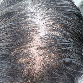 ME Medspa - Before - Medical Spas Near Me - Monterey Park, California
