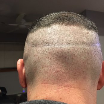 Scalp Micro USA - After session 2 - Hair Loss Centers Near Me - New York, New York Scalp Micro USA - After session 2 - Hair Loss Centers Near Me - New York, New York