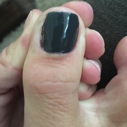 Just one of my toes and this was after it was "fixed" Just one of my toes and this was after it was "fixed"