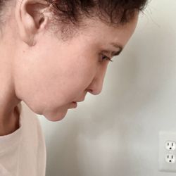 Skin & Vein Center - Double Chin after lower face/neck lift