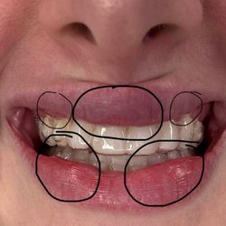 Goldfingers Aesthetics Daytona - I circled the uneven areas. Very noticeable when smiling.