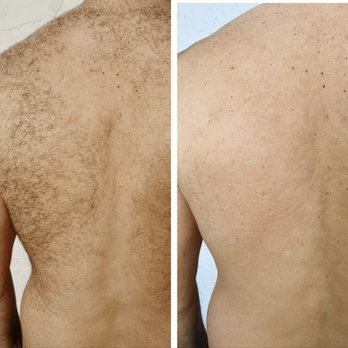 Posh Laser Studio - What an amazing result! Laser hair removal for men. - Laser Hair Removal Near Me - Plano, Texas Posh Laser Studio - What an amazing result! Laser hair removal for men. - Laser Hair Removal Near Me - Plano, Texas