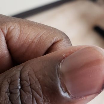 99 Elegant Nail - Thumb healing after drilling too closely. 7 days later. - Nail Salons Near Me - Douglasville, Georgia 99 Elegant Nail - Thumb healing after drilling too closely. 7 days later. - Nail Salons Near Me - Douglasville, Georgia