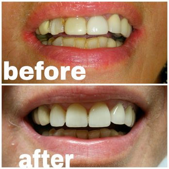 Yuri Krainov, DDS - 3 upper front teeth restoration done in our office - General Dentistry Near Me - Brooklyn, New York Yuri Krainov, DDS - 3 upper front teeth restoration done in our office - General Dentistry Near Me - Brooklyn, New York