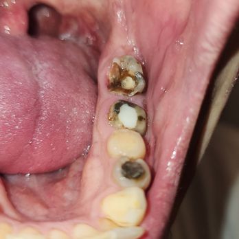 Windsor Implant & Cosmetic Dentistry - Condition of my mouth after 14 months. Still no response from the owners. This is Dr. Brown's work that insurance has paid over $9000 for! - General Dentistry Near Me - Windsor, Connecticut Windsor Implant & Cosmetic Dentistry - Condition of my mouth after 14 months. Still no response from the owners. This is Dr. Brown's work that insurance has paid over $9000 for! - General Dentistry Near Me - Windsor, Connecticut