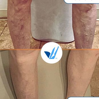 USA Vein Clinics - Home Health Care Near Me - San Antonio, Texas USA Vein Clinics - Home Health Care Near Me - San Antonio, Texas