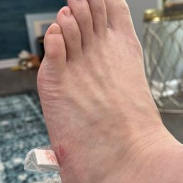 Flesh wound from pedicure