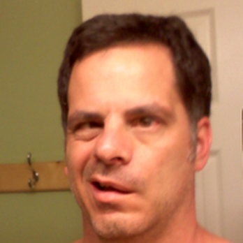 Zhihong Acupuncture Clinic - Client with Bell Palsy before he came in for treatment - Acupuncture Near Me - Orange, California Zhihong Acupuncture Clinic - Client with Bell Palsy before he came in for treatment - Acupuncture Near Me - Orange, California