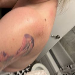 Dominican Hospital - More red raised spots on my back and neck. You can't see apparently.