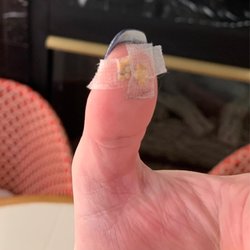 Mu Chinese Acupuncture & Herbs - Acupressure to thumb for 3 hours during a migraine crisis