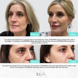 beyond AESTHETICS - Above photo a patient treated for a full face filler package.
Below photo is a patient who received under eye filler.