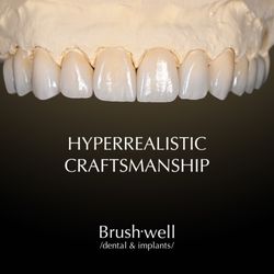 Brushwell Dental and Implants - Custom hand-layered ceramic veneers personalize for each patient by our award-winning master ceramist