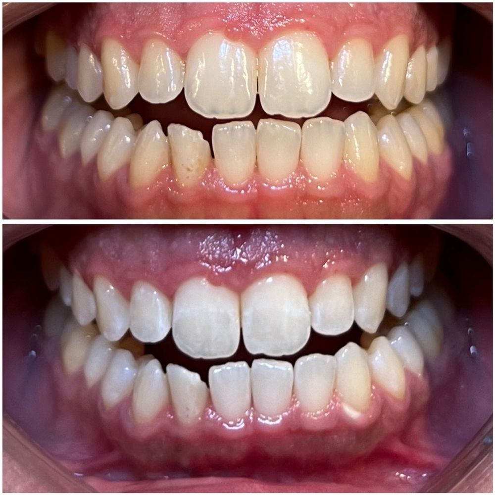 Deebeaut - Teeth Whitening Near Me Deebeaut - Teeth Whitening Near Me