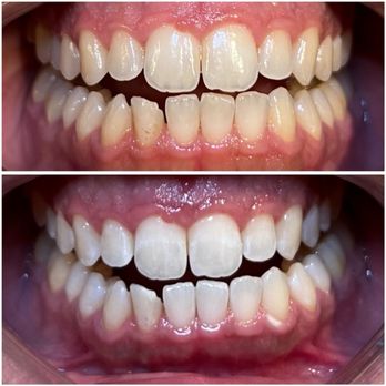 Deebeaut - Teeth Whitening Near Me