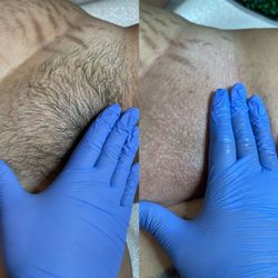 Bare Skin By Liz - Brazilian Wax Before and After.