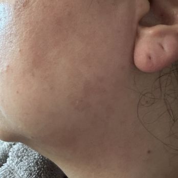 Revive Med Spa - Burns on left side jawline - Medical Spas Near Me - Roseville, California Revive Med Spa - Burns on left side jawline - Medical Spas Near Me - Roseville, California
