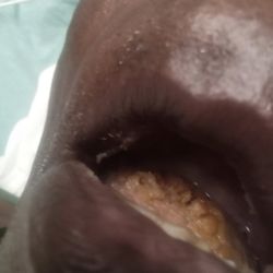 Emerald Coast Care Center - thrush of mouth and tongue