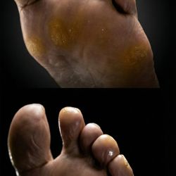 Advanced pedicure