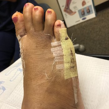 Richard R Moy, DPM - One week after surgery. - Podiatrists Near Me - Foothill Ranch, California Richard R Moy, DPM - One week after surgery. - Podiatrists Near Me - Foothill Ranch, California