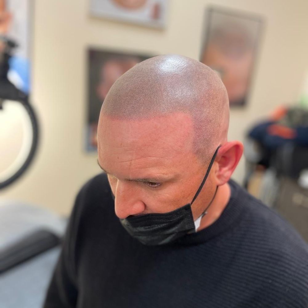 Hair Transplant Westminster California