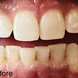 Illumination Teeth Whitening - This is a before teeth whitening!