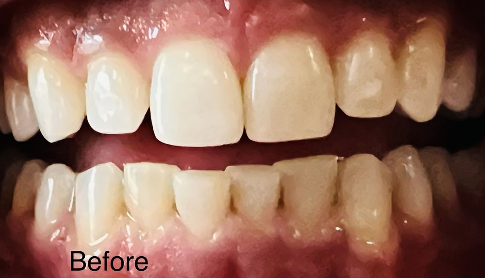 Illumination Teeth Whitening Logo