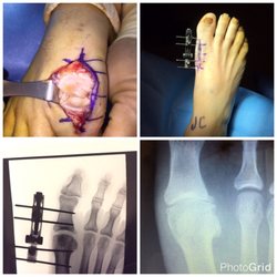 Parkson J Lin, DPM - Hallux limitus surgery with mini external fixator and Amniox amniotic tissue graft.