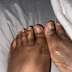 Dakota Nail Spa - Healing from fungus infection at Dakota Spa