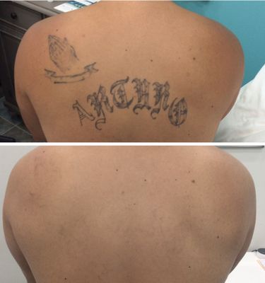 Bare Tattoo Hair Removal Closed 2019 All You Need To Know