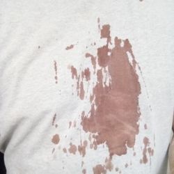 Smilebuilderz - My ruined shirt immediately after surgery.
