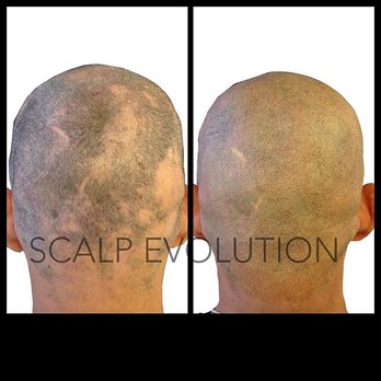 Scalp Evolution - Hair Loss Centers Near Me - Miami, Florida Scalp Evolution - Hair Loss Centers Near Me - Miami, Florida