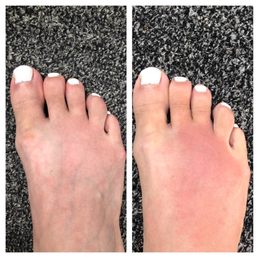 Bee sting from day one until day 2. Bee sting from day one until day 2.