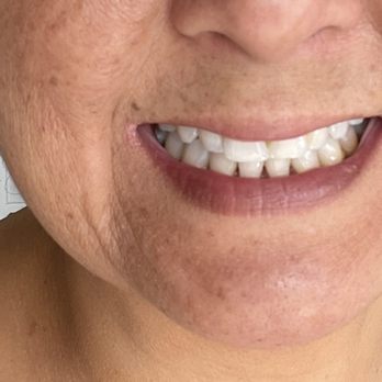 Trinh Phil, DDS - My teeth after a cleaning at Dr Chu's office painless and amazing - General Dentistry Near Me - Garden Grove, California Trinh Phil, DDS - My teeth after a cleaning at Dr Chu's office painless and amazing - General Dentistry Near Me - Garden Grove, California