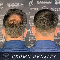 Newport SMP - Density Treatment by Nurse Shawna