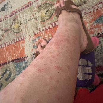 LaserAway - This is my lower leg RIGHT AFTER treatment. - Medical Spas Near Me - Las Vegas, Nevada LaserAway - This is my lower leg RIGHT AFTER treatment. - Medical Spas Near Me - Las Vegas, Nevada