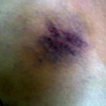 Pain Stop Wellness - Part of the bruising from my last massage - Massage Near Me - Chicago, Illinois Pain Stop Wellness - Part of the bruising from my last massage - Massage Near Me - Chicago, Illinois