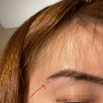 Arlington NOVA Laser & 3D Microblading - my face got cut - Eyebrow Services Near Me - Arlington, Virginia Arlington NOVA Laser & 3D Microblading - my face got cut - Eyebrow Services Near Me - Arlington, Virginia