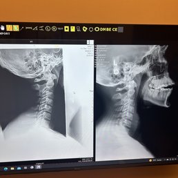 X-Ray before/after X-Ray before/after
