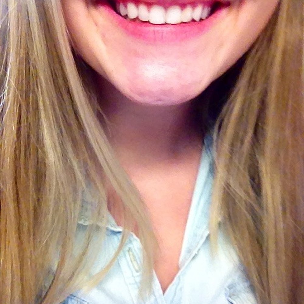 The finished product after bonds on my left central and lateral incisors!