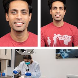 Pennbrook Dentistry - Dr. Patel apply teeth whitening treatment