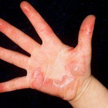 Pluckers Wing Bar - Plano - My hand burnt - Chicken Wings Near Me - Plano, Texas Pluckers Wing Bar - Plano - My hand burnt - Chicken Wings Near Me - Plano, Texas