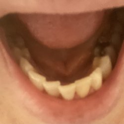 Northeast Orthodontics - Lower teeth not much difference from 1 1/2 yrs prior.