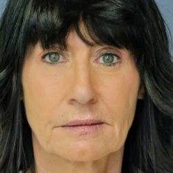 Smith Cosmetic Surgery - BEFORE