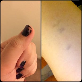 Secret Nails - My one day old gel manicure, and the bruises left by her surprise upper arm "massage" - Nail Salons Near Me - Las Vegas, Nevada Secret Nails - My one day old gel manicure, and the bruises left by her surprise upper arm "massage" - Nail Salons Near Me - Las Vegas, Nevada