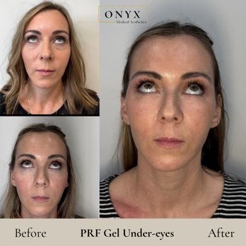 Onyx Medical Aesthetics - Natural filler with PRF gel - the latest regenerative aesthetic treatment 100% natural. - Aestheticians Near Me - Lacey, Washington Onyx Medical Aesthetics - Natural filler with PRF gel - the latest regenerative aesthetic treatment 100% natural. - Aestheticians Near Me - Lacey, Washington