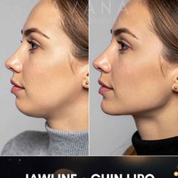 Avana Plastic Surgery - Jawline surgery before and after