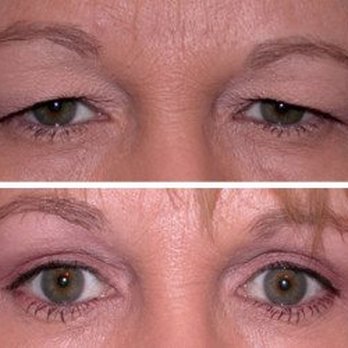 DiGeronimo MD Advanced Plastic Surgery: Ernest DiGeronimo, MD - Upper and lower Blephoplasty (Eyelids) - Cosmetic Surgeons Near Me - Miami, Florida